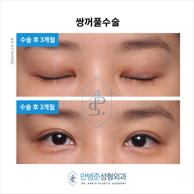 [강남성형외과] 쌍꺼풀수술 정보 - 절개법 수술사례 관련 이미지 4