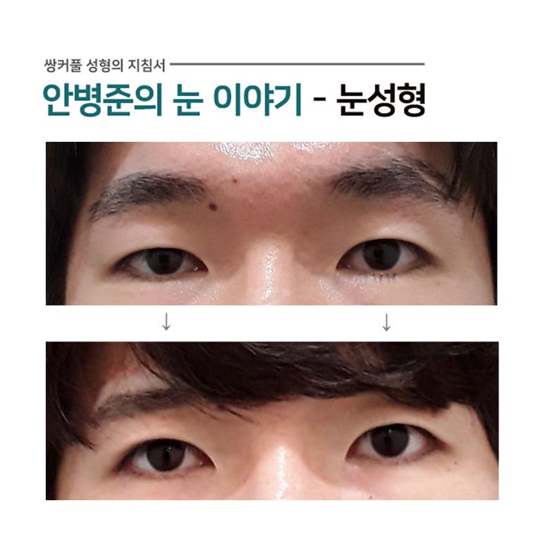 남자 쌍꺼풀 사례(안검하수,꺼진눈)#3~4 관련 이미지 2