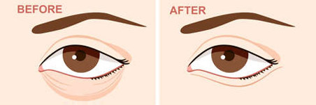 [강남역성형외과] 눈썹거상술? 눈썹밑절제술? 눈밑지방재배치? 관련 이미지 5