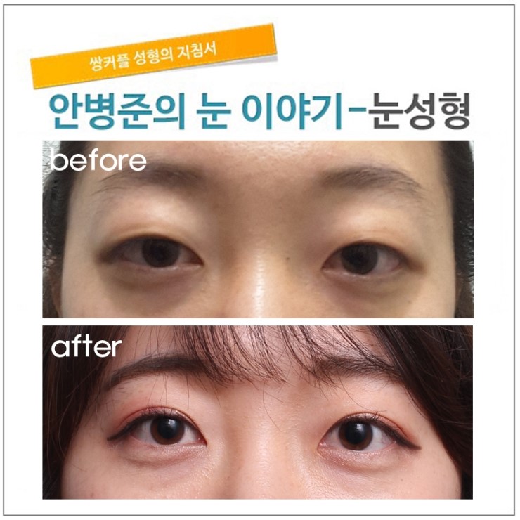피부가 처진 눈.(절개법,피부절제) 관련 이미지 1