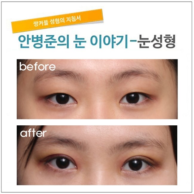 눈성형 수술엔 환자의 협조도 꼭 필요합니다. 관련 이미지 1