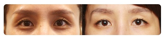 쌍꺼풀 라인크기 두껍게 한다고 정답은 아닙니다 관련 이미지 6