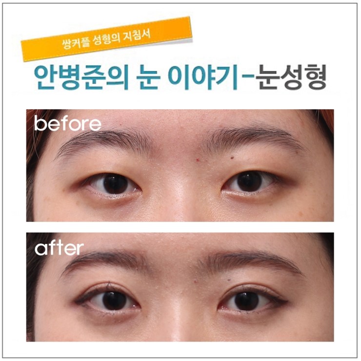 매몰법보다 절제술.(절개법,피부절제) 관련 이미지 1