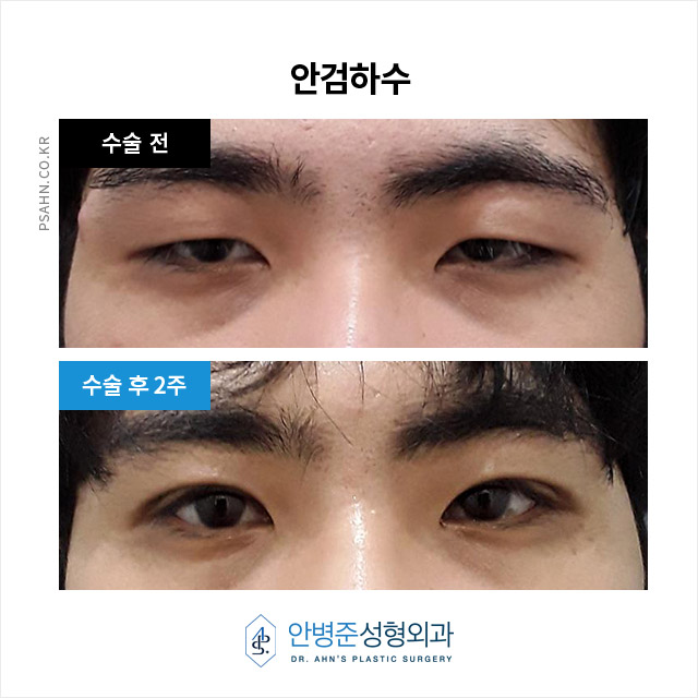 [남자눈성형] 눈의 피로를 덜고 밝은 인상을 되찾는 방법 중 하나! 관련 이미지 5