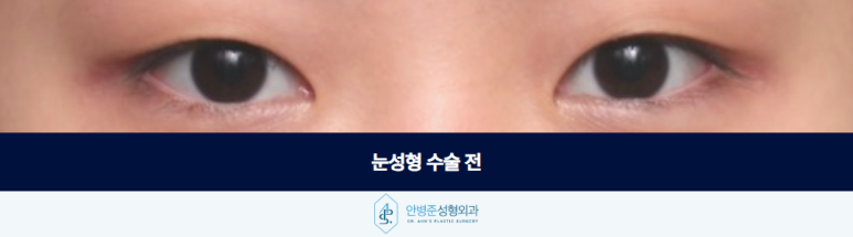 눈성형 수술 전문의와 함께 소통하면서 만들어지는 결과입니다 관련 이미지 2