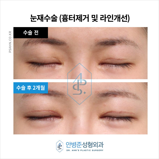 [강남역성형외과] 네 번째 쌍꺼풀 재수술, 고민 끝에 찾은 해결방법! 관련 이미지 3