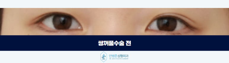 쌍꺼풀수술병원 선택 기본부터 충실한지 살펴보세요 관련 이미지 2