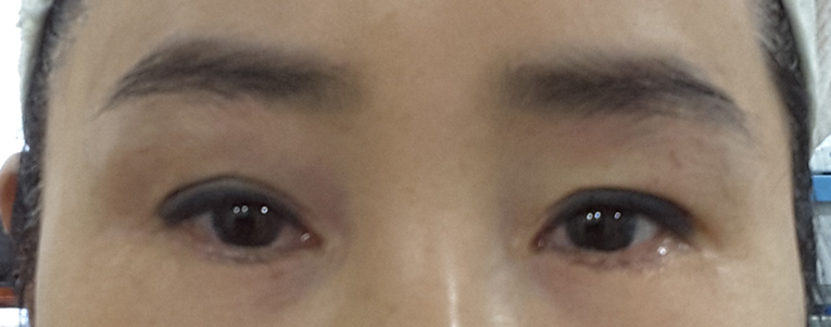 효과 좋은 지방이식 방법 관련 이미지 7