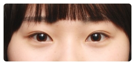 수술후 1개월 경과후&눈감은 모습             [안병준의 눈이야기] 관련 이미지 4