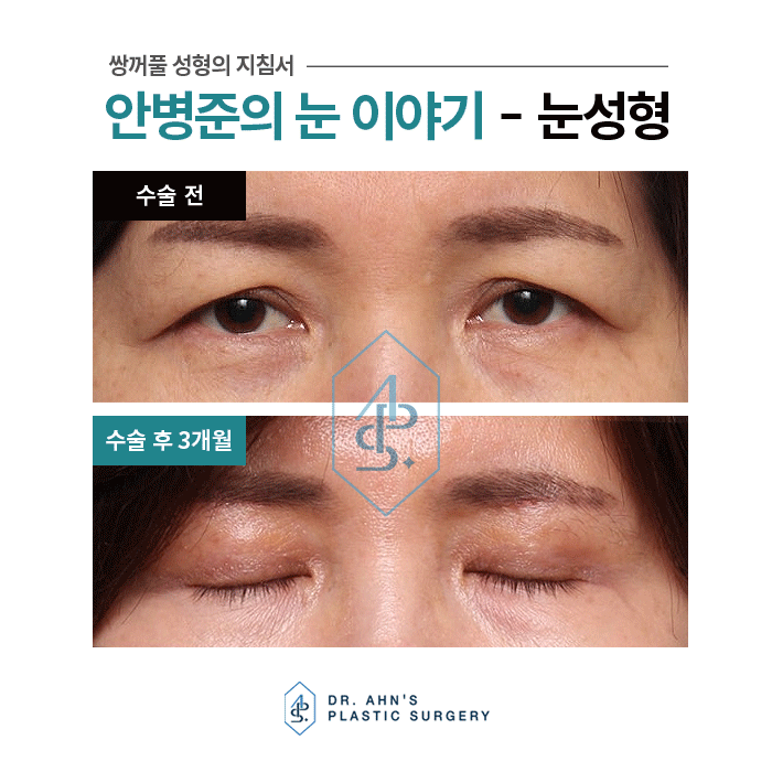 [눈썹밑상안검] 졸려보이는 눈매 및 처진 눈꺼풀 개선 관련 이미지 4