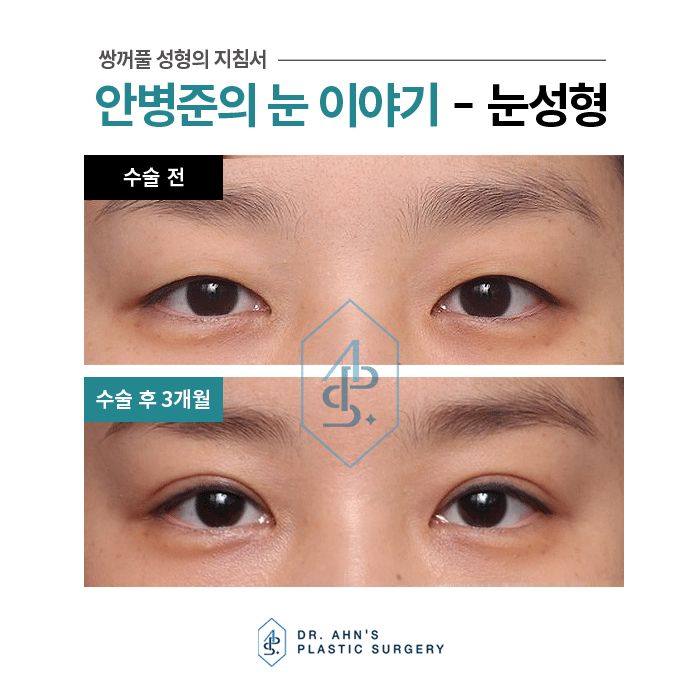 [자연스러운 쌍꺼풀] 4일째 실밥제거 / 3개월 후 사진 관련 이미지 7