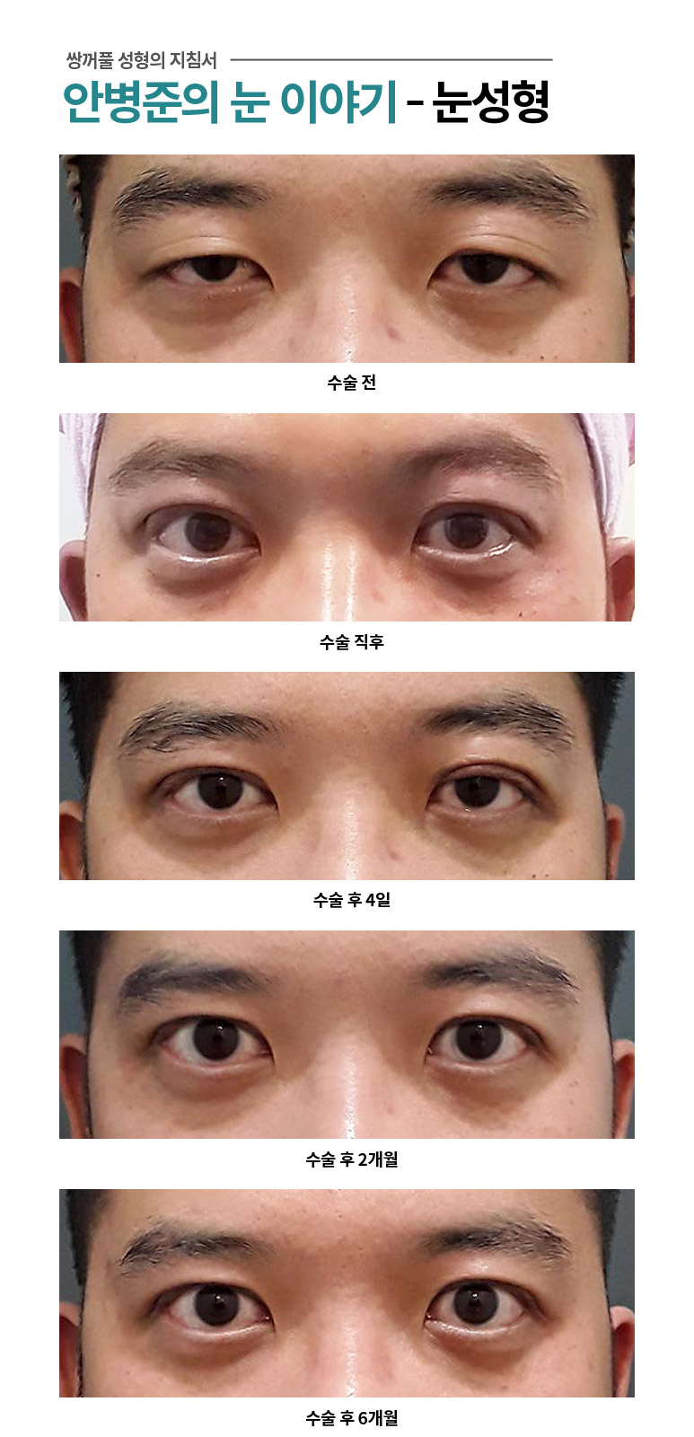 안검하수가 심한경우. 눈꺼풀피부가 처진상태 - 눈매교정술 관련 이미지 1