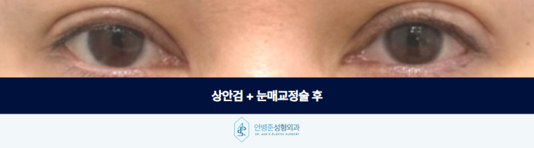 상안검 수술 눈매교정술 함께 정리해야 하는 경우가 있습니다 관련 이미지 3
