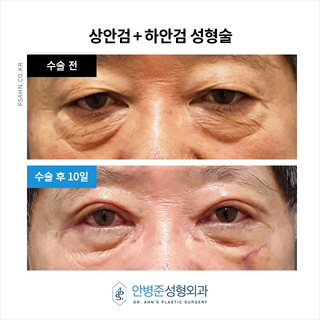 [상안검,하안검]100세 시대, 남성 상하안검성형술의 새로운 관심 관련 이미지 8