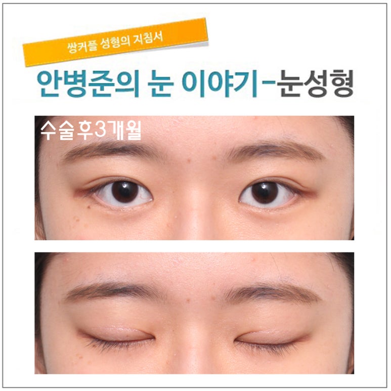 동양인 눈(자연 쌍꺼풀,자연스러운쌍꺼풀수술) 관련 이미지 3