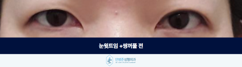 눈윗트임 쌍꺼풀 안검하수라고 섣불리 눈매교정하기보다는 관련 이미지 2