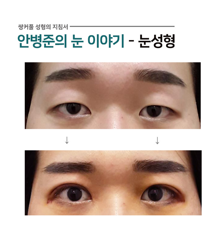 남자눈 일반적 수술방법 #2.(진짜 안검하수,피부절제,윗트임,가짜 안검하수) 관련 이미지 1