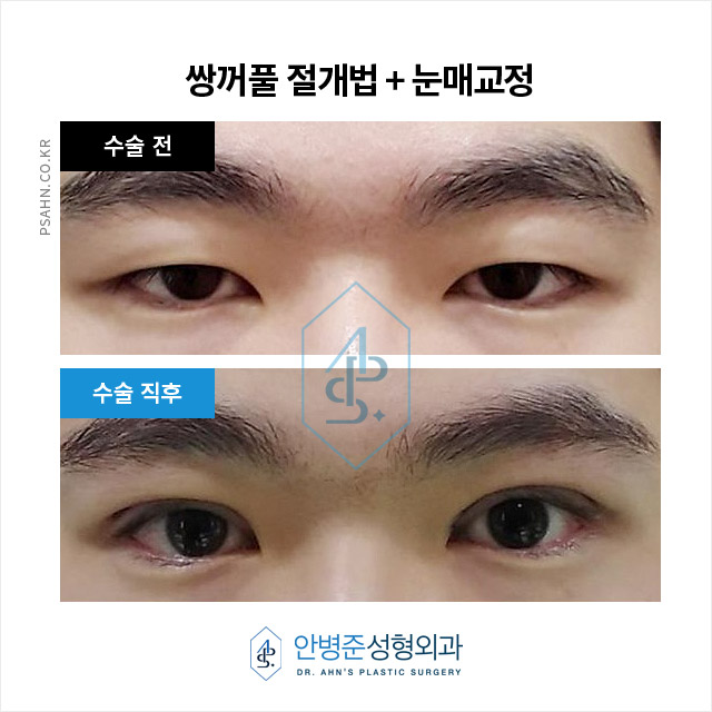 [남자쌍꺼풀] 남성 눈매 교정 - 안검하수와 처진 눈꺼풀 수술사례 관련 이미지 2