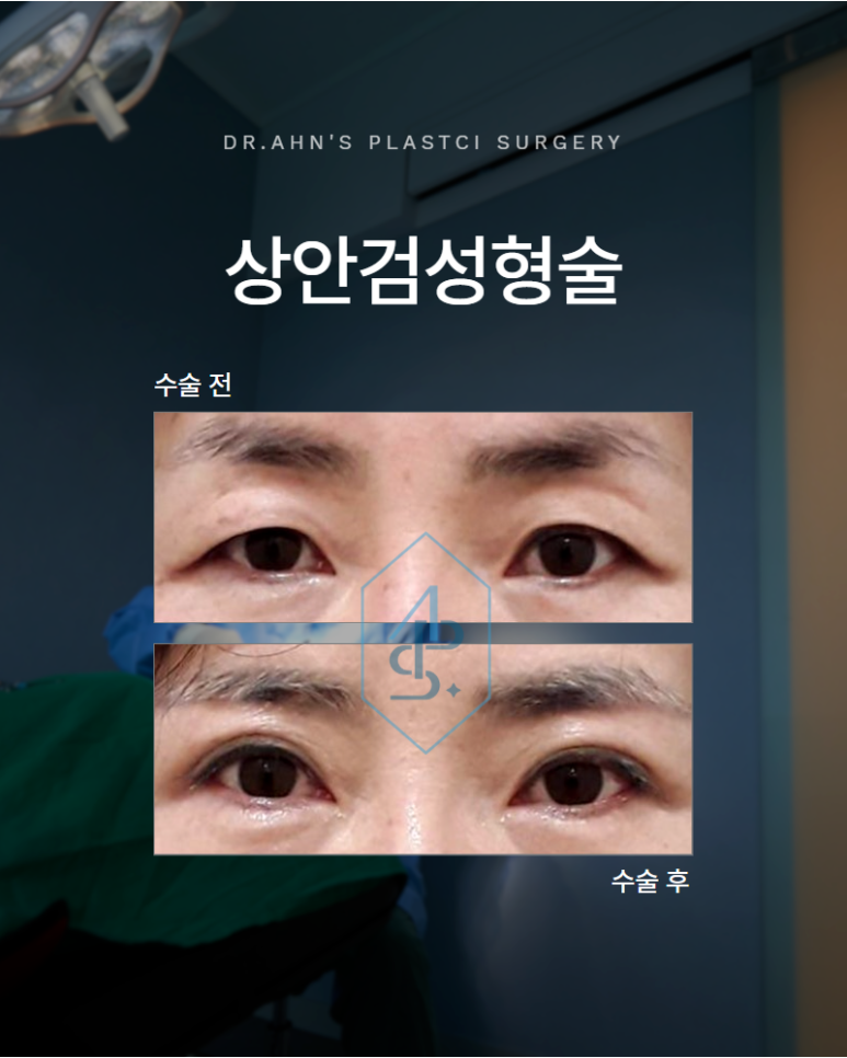 상안검성형술 눈꺼풀 처짐이 심하다면 이것까지 고려해야 합니다 관련 이미지 1