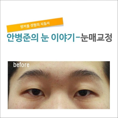 쌍꺼풀&앞트임 2달후.  [안병준의 눈이야기] 관련 이미지 1