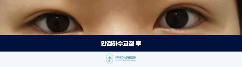 안검하수교정 눈이 항상 무겁고 피곤해 보인다면 관련 이미지 3