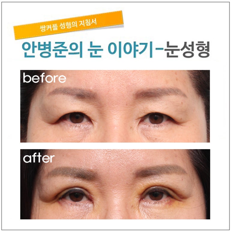 상안검성형술 관련 이미지 1