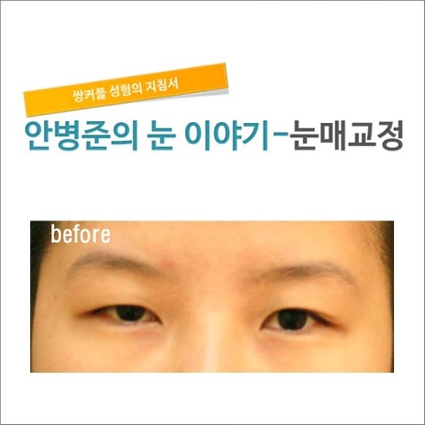 수술 직후.   [안병준의 눈이야기] 관련 이미지 1