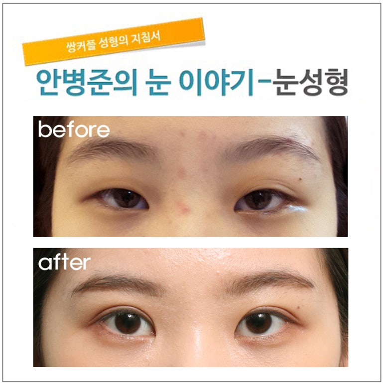 짝짝이눈 수술(짝눈교정,눈매교정) 관련 이미지 1