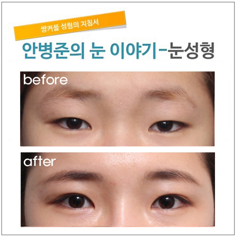자연스러운 속쌍꺼풀(속쌍꺼풀수술,피부절제,쌍꺼풀수술) 관련 이미지 1
