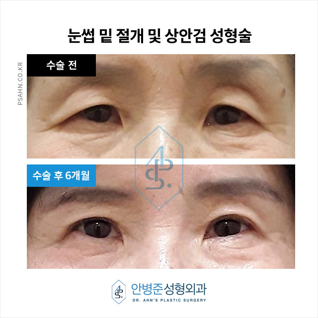 100세 시대, 50~70세에도 성형, 걱정하지 마세요! 관련 이미지 4