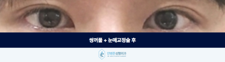 쌍꺼풀 수술 눈매교정술 남성 눈에서 더 신경 써야 하는 부분 관련 이미지 3