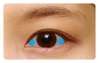 삼백안이란? 원인과 교정 관련 이미지 1