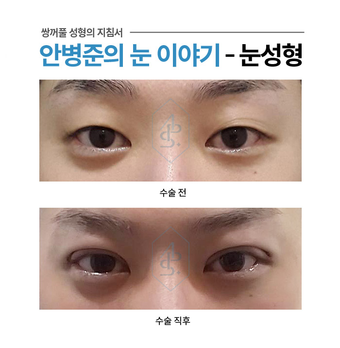 쌍꺼풀 수술에서 부기란? - 수술직후 붓기 사례 모음 관련 이미지 8