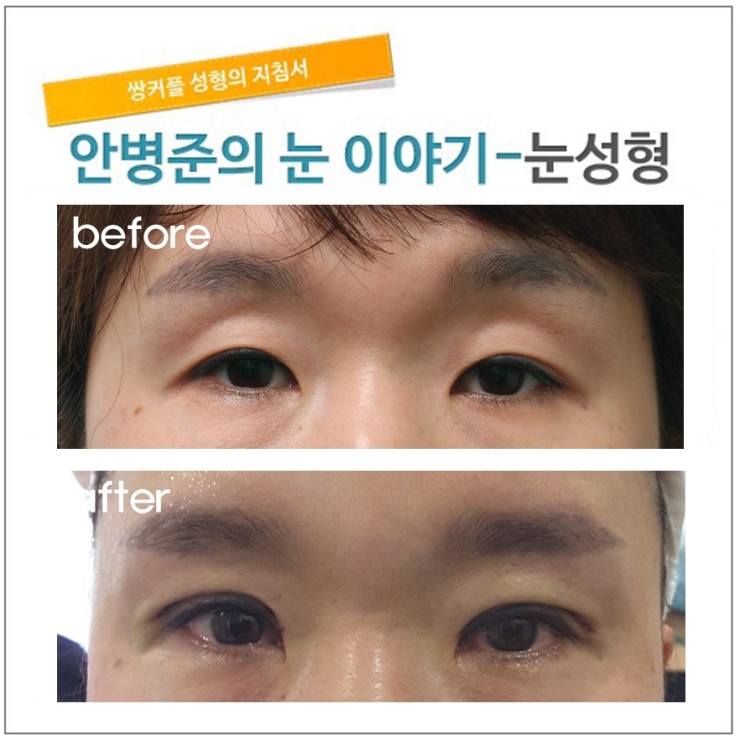 지방감소 눈꺼풀.(꺼진눈,꺼진눈수술,상안검성형,지방재배치) 관련 이미지 1