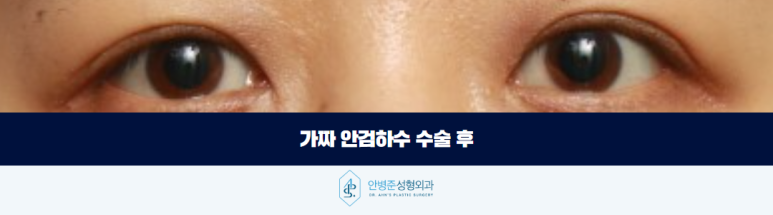 안검하수 눈매교정 가짜와 진짜를 구분해야 합니다 관련 이미지 4