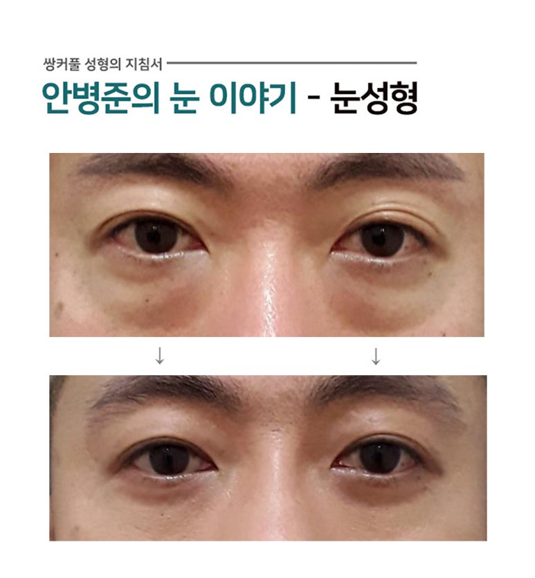 쌍꺼풀과 다크서클(하안검술,눈밑지방제거) 관련 이미지 1
