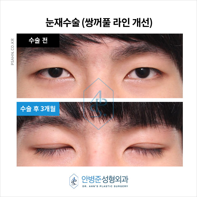 남성 쌍꺼풀재수술,자연스러운 라인과 문제 해결 방안 관련 이미지 2