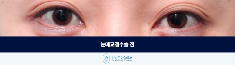 When Double-Eyelid Surgery Alone Is Not Enough for Creased Folds and Sunken Eyelids: Eye-Opening Correction Surgery image 2