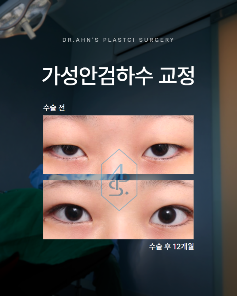 가성안검하수 알고보면 이 부분이 원인일 수 있습니다 관련 이미지 1