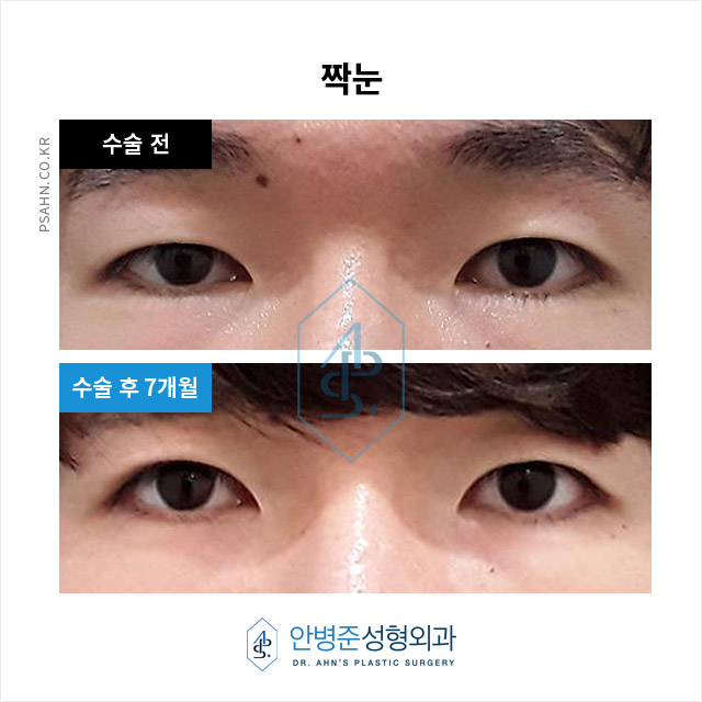 [남자눈성형] 남자 쌍꺼풀, 여자와 다른 자연스러움의 포인트? 관련 이미지 5