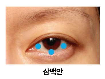 [쌍꺼풀수술] 이백안과 삼백안! 그것이 알고 싶다~! 관련 이미지 3