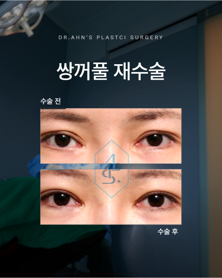 쌍꺼풀 재수술 잘하는병원 여러 번 수술한 눈일수록 이것이 필요합니다 관련 이미지 1