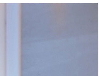 여자 눈매교정 안검하수 또렷하면서도 부드러운 인상을 찾다 관련 이미지 11