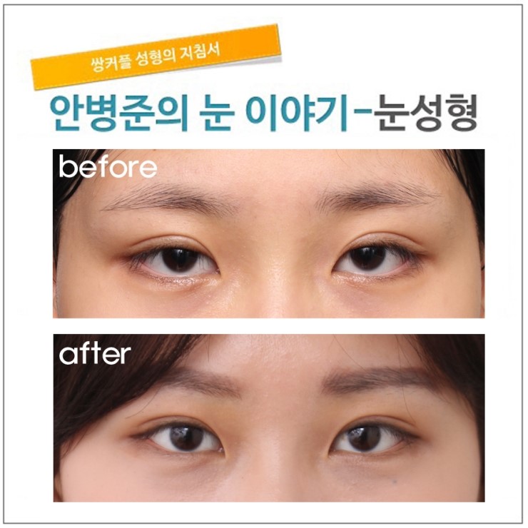 안검하수 외의 눈매교정이 필요한 경우.(안검하수,눈매교정) 관련 이미지 4
