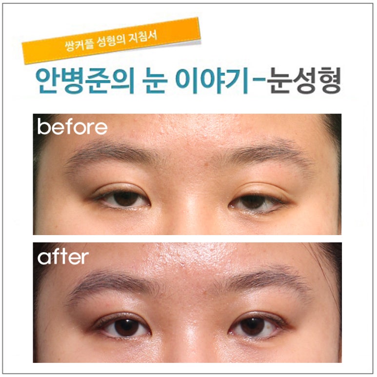 중증도의 안검하수(근육전진술,눈매교정,안검하수,재수술) 관련 이미지 1