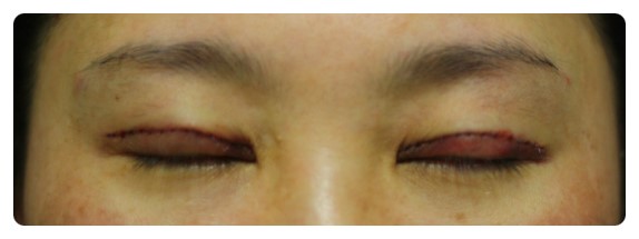 -소시지눈 고치기 과정-        [안병준의 눈이야기] 관련 이미지 9