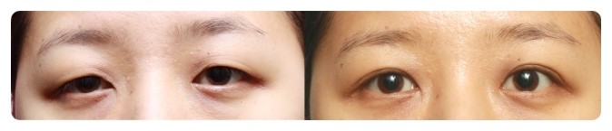 안병준의 쌍꺼풀 지침서4_쌍꺼풀수술 왜 하는가? 관련 이미지 3