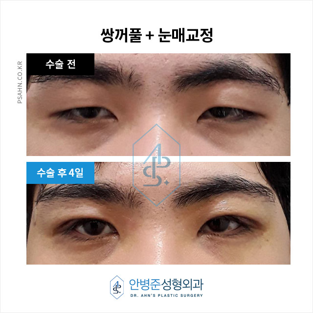 [남자쌍꺼풀]남성 안검하수, 답답함 벗고 활력을 되찾는 눈매 교정 관련 이미지 1