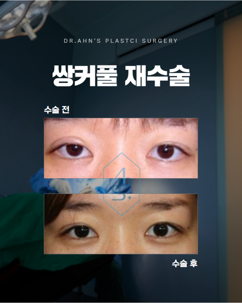 쌍꺼풀 라인크기 두껍게 한다고 정답은 아닙니다 관련 이미지 1