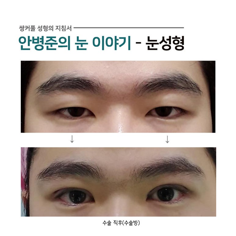쌍꺼풀 수술을 원하는 남자들의 목적(쌍수,피부처짐,안검하수,눈꺼풀피부제거,눈매교정) 관련 이미지 1